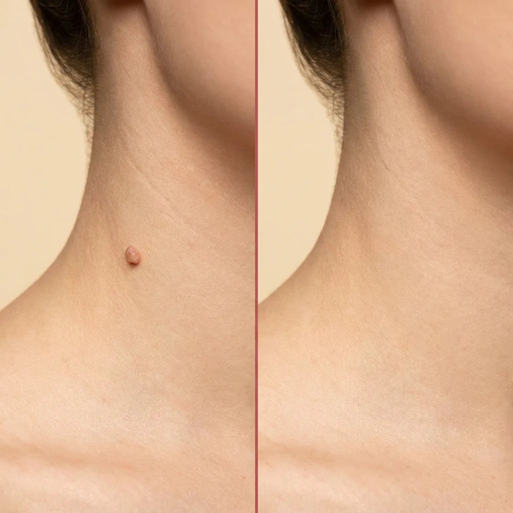 ClearTag Microneedle Skin Tag Patch