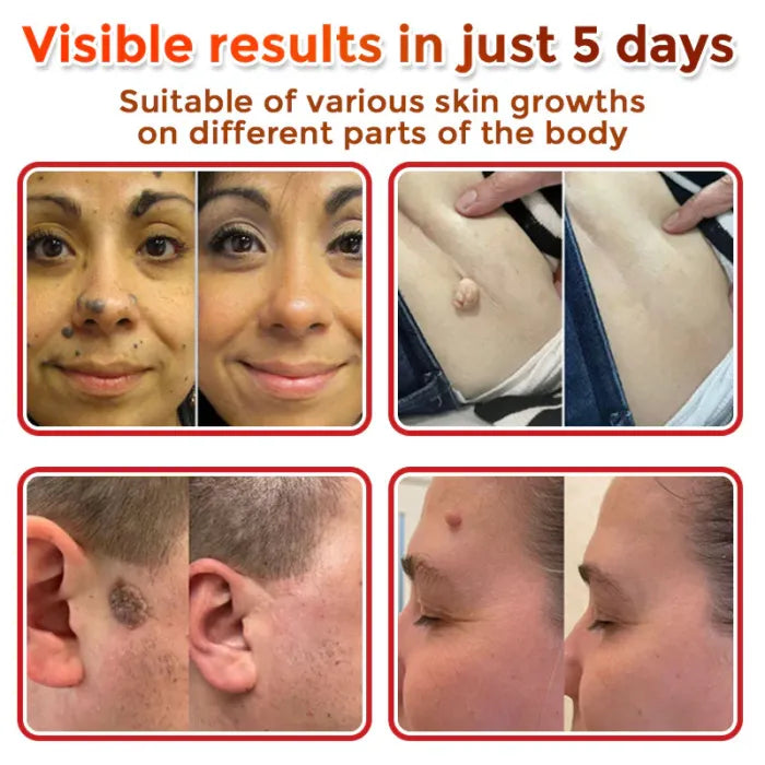 ClearTag Microneedle Skin Tag Patch